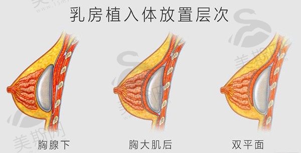 假体隆胸