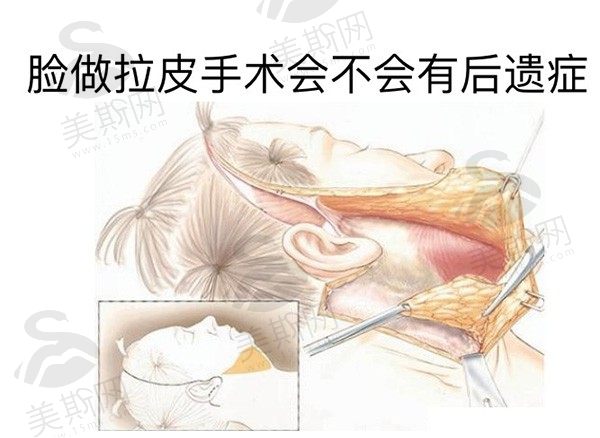 SMAS除皱术