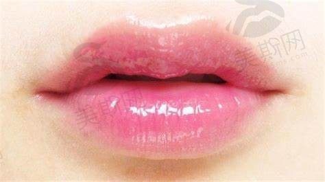 M唇、花瓣唇和嘟嘟唇区别是什么?丰唇的方法有哪些?