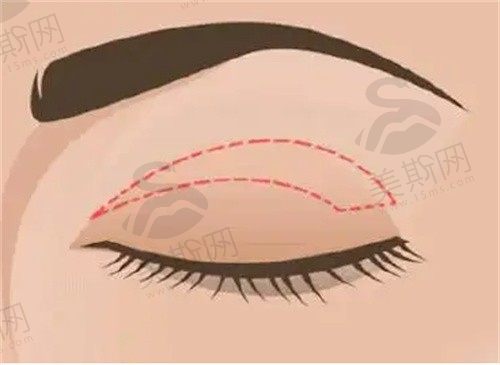 苏州圣爱美容医院双眼皮价格8800+，阳运发做双眼皮技术真给力