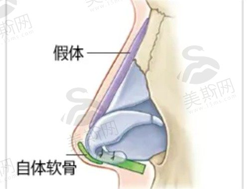 杭州清锴做鼻子可正规啦,隆鼻整形医生经验足做鼻修复也好的很