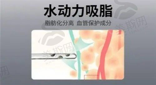 深圳景田万晓楠吸脂手术做得很精细，水动力大腿吸脂3880元起很​香