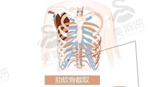 去韩国优雅人整形做自体肋软骨鼻手术真实经历分享:隆鼻术后超美