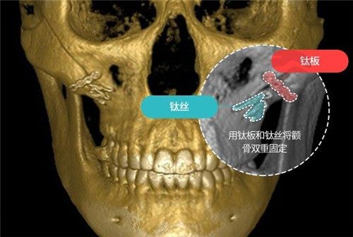 韩国ts整形李相均医生做颧骨缩小还能防下垂,手术真实经验分享