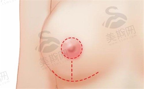 韩国ts整形外科胸部下垂矫正价格4万+,技术贼好术后胸超Q弹