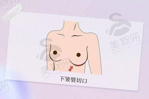 杭州美莱栗勇做假体隆胸技术非常好，他做的下皱襞切口隆胸很火的