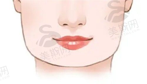 重庆松山医院做下颌角整形手术真例分享:把我的方脸变成小v脸啦