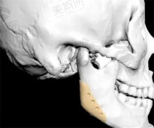 3d打印人工骨修复下颌角效果图告诉你，peek材料修复下颌骨为何贵