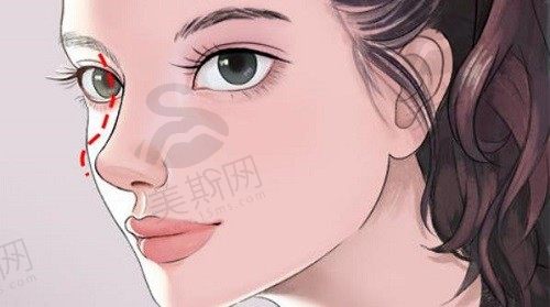 重庆李任医生隆鼻案例真实分享：真正做出我想要的层次性自然美鼻