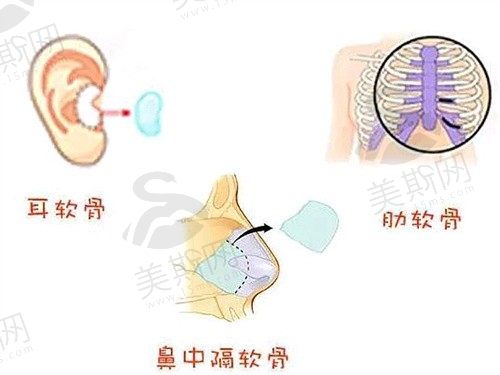 做鼻子用耳软骨还是肋骨？有姐妹说耳软骨隆鼻两年后回缩是真的吗？