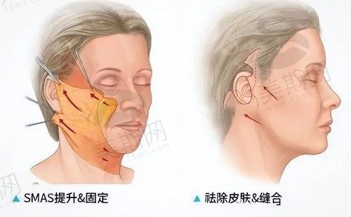 筋膜悬吊术手术过程是怎样做的？探索筋膜悬吊术和拉皮和线雕的区别