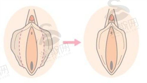 小阴唇肥大整形有必要吗？阴唇矫正手术原理+私密整形费用你要了解