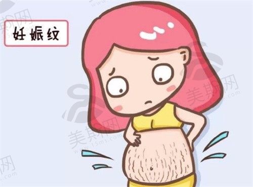 10多年的妊娠纹怎么祛除？激光/切皮手术去妊娠纹修复方法大曝光