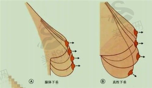 乳房下垂悬吊术多少钱?是怎么做的?乳房下垂悬吊术费用/后遗症全了解