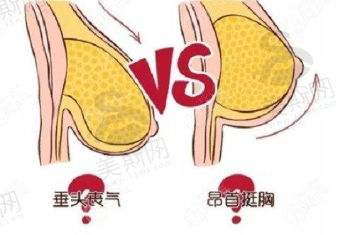 乳房悬吊提升手术可以保持多久？褶皱能恢复吗？多久可以上班