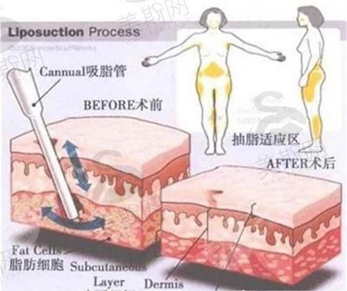 富贵包怎么消除有效的方法是什么？吸脂or手术切除怎么选深度分析