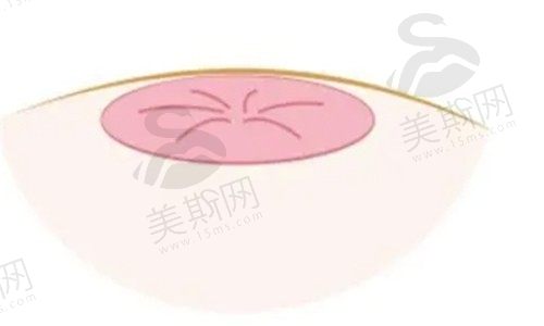 乳头内陷22岁矫正还来得及吗？矫正后会再内陷吗手术矫正费用多少