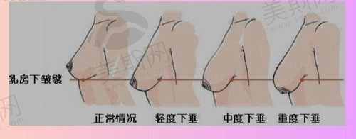 乳房悬吊提升手术后皱巴巴的原因及恢复对策：褶皱多久会平