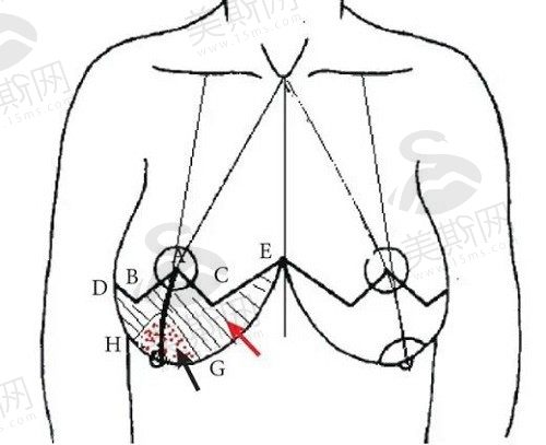 乳房悬吊术后依旧下垂怎么办？乳房悬吊术后注意事项&后遗症解析