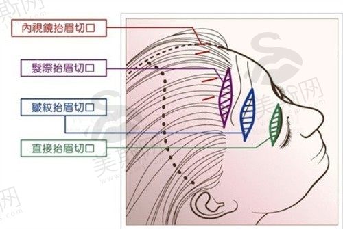 无痕提眉术和缝合提眉术比较哪个效果更好?无痕切眉术多久可以恢复自然