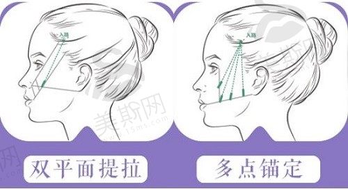 微拉美和拉皮手术有什么区别？维持时间&手术过程&副作用综合了解