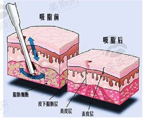 广州军美王世虎做吸脂怎么样？做精细柔性手工吸脂抽出满满纯脂肪