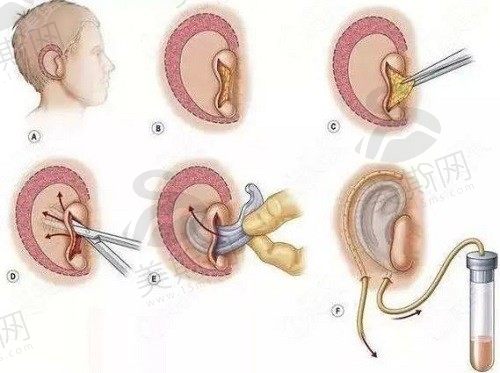 耳再造是自体软骨好还是生物材料好？分析两者利弊就知怎么选