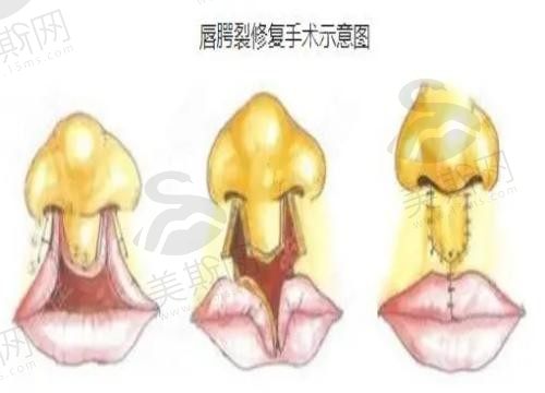 兔唇修复手术什么时候做适合？兔唇需要做几次手术才能做好？