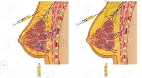 纳米脂肪丰胸好还是脂肪胶丰胸好？各有优势,具体区别看这篇就够