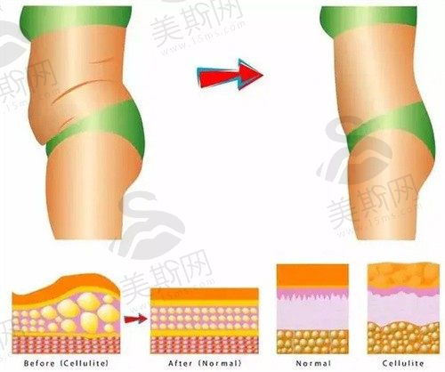 5g光雕吸脂后可以正常走路吗？一次能做几个部位？穿多久的塑身衣合适？