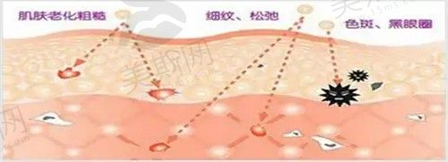 光子嫩肤多久能洗脸？光子嫩肤术后注意事项及护理方法都在这儿