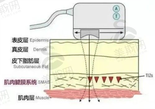 上海首尔丽格医疗美容超声炮怎么样？正规黄金超声炮除皱很有效