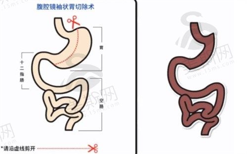 袖状胃切除手术是什么？袖状胃手术的利与弊详解-袖状胃切除手术后遗症和价格