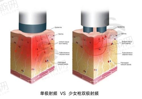 芮艾瑅少女枪对馒化脸的功效：可以有效消除馒化脸维持时间挺长的