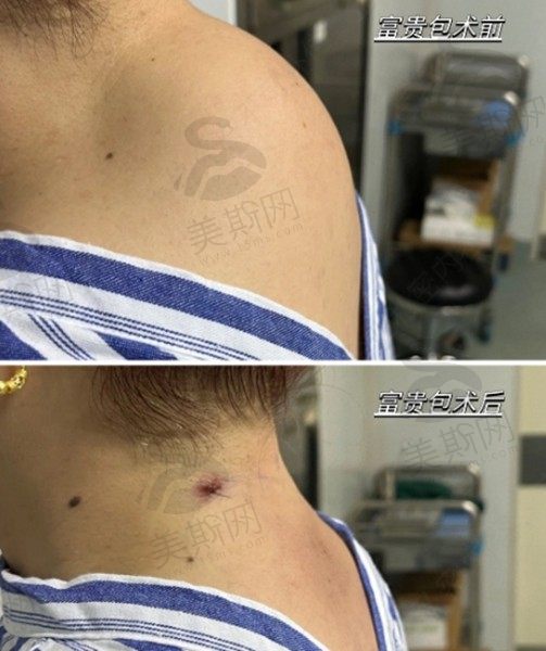惠州黄学峰富贵包医疗美容案例2