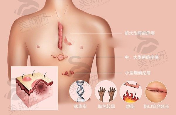 成都友谊医院疤痕科怎么样啊多少钱？苏卫峰激光祛疤780元/3cm²医院有SRT100