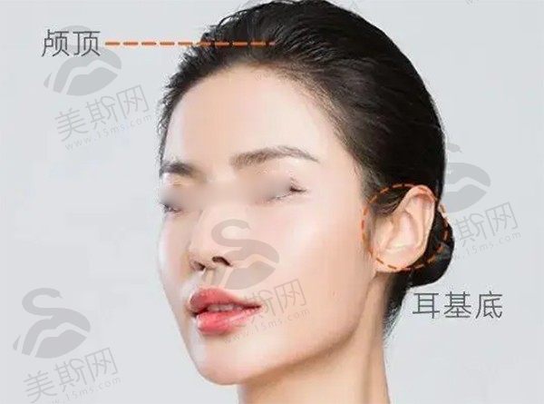 高亚东拉皮手术技术怎么样？小拉皮效果好，价格4.98万元起，性价比超高！