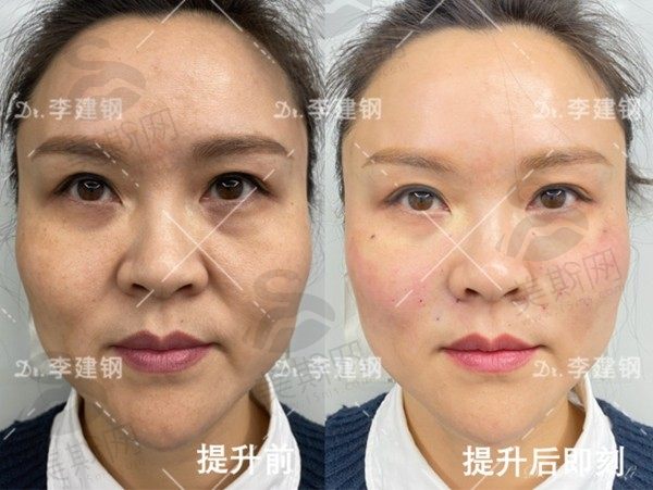 成都李建刚筋膜提升多少钱？正规医院技术靠谱，无痕筋膜提升约2万-10万元
