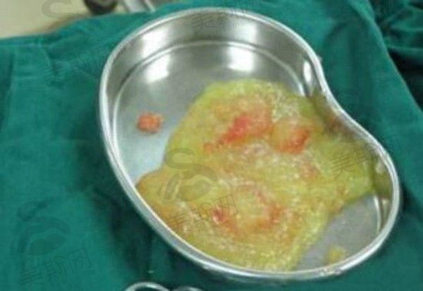 奥美定的危害和副作用有多可怕？面部发硬、游离变形，不取出后果不堪设想！