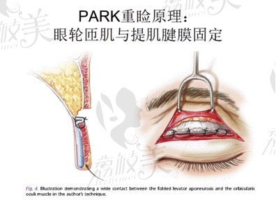 罗曼做双眼皮怎么样？