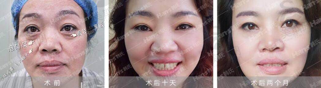 北京韩啸医疗美容门诊部综合去眼袋