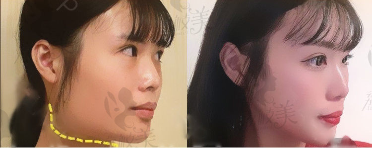 杭州华山连天美医疗美容医院院长高俊明下颌角手术<span style=