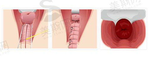 尹虎珠博士阴道缩阴手术与传统的阴道紧缩术区别