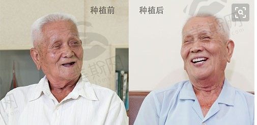 湛江退休干部爷爷全口数字化种植