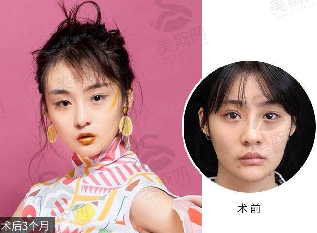 新星靓医疗美容医院全面部线 雕提升案例