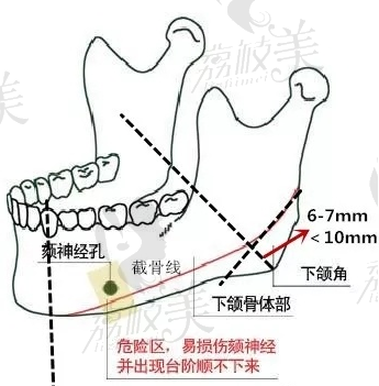 上海伊莱美李湘原院长下颌截骨范围