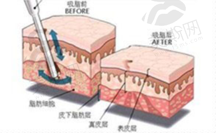 徐铎院长独有的抽注双流程脂肪舒缓按摩