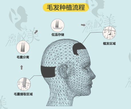 毛发种植流程