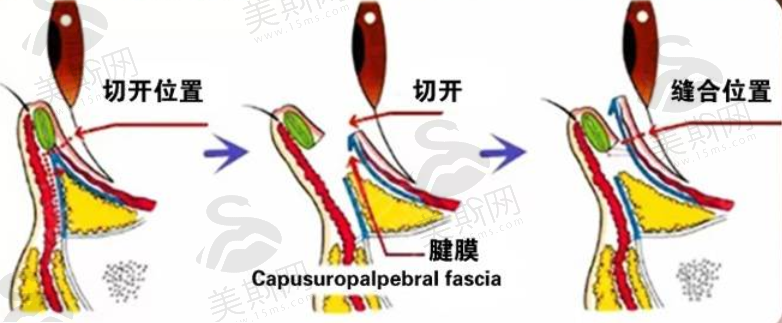 重庆军美整形医院眼部整形