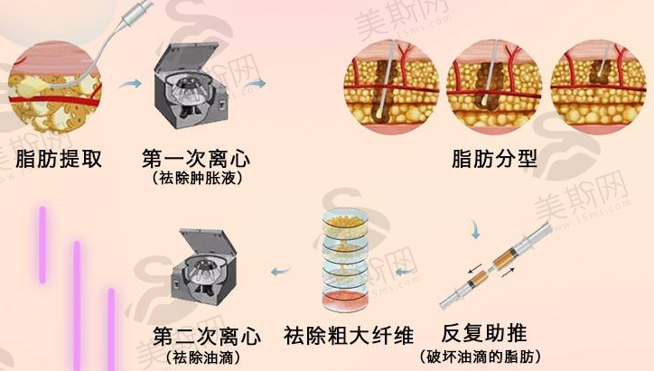 重庆军美整形SVF脂黄金双心脸项目